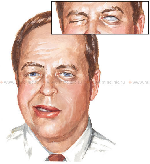 With neuritis of the facial nerve, the patient cannot close the eye (the eyeball turns upward, exposing the sclera (Bell's phenomenon) because the eyelids do not close), wrinkle the forehead, and show teeth (when trying to smile) on the affected side. In this case, the lower eyelid and lower lip will be slightly lowered.